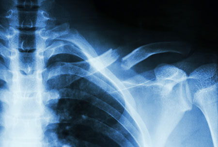 Broken Bone X-Ray, Car Accident Injuries