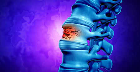 spinal fracture, spinal cord injuries after car accidents